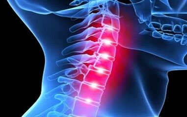 Servikal omurganın osteokondroz semptomları