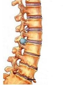 Servikal bölgenin osteokondrozu nasıl gelişir