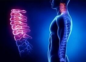 Servikal osteokondrozun gelişiminin nedenleri