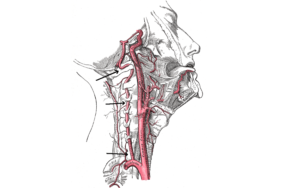 Vertebral arterin servikal osteokondroz ile sıkışması