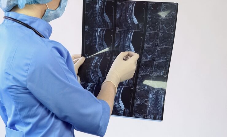 Servikal osteokondroz tanısı MRI çalışmasına dayanarak konur