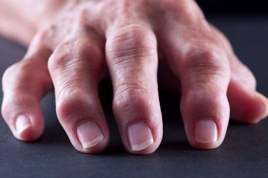 Artroz veya artrit nedeniyle parmaklarda eklem deformiteleri